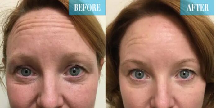 Scarlet rf microneedling